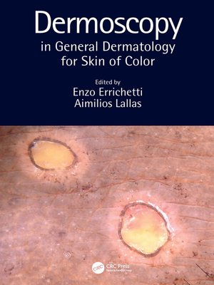 cover image of Dermoscopy in General Dermatology for Skin of Color